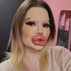 25-Year-Old Bulgarian Woman Has More Than 27 Procedures To Have The Biggest Lips In The World