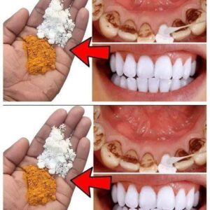 Natural Remedies with Cloves and Bay Leaves for a Brighter Smile…