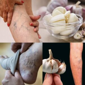 Natural Remedy For Leg Pain, Rheumatism, Varicose Veins, Arthritis, Headaches, And Joint Pain With Garlic