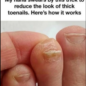 Thick Toenails: Treatments and Home Remedies